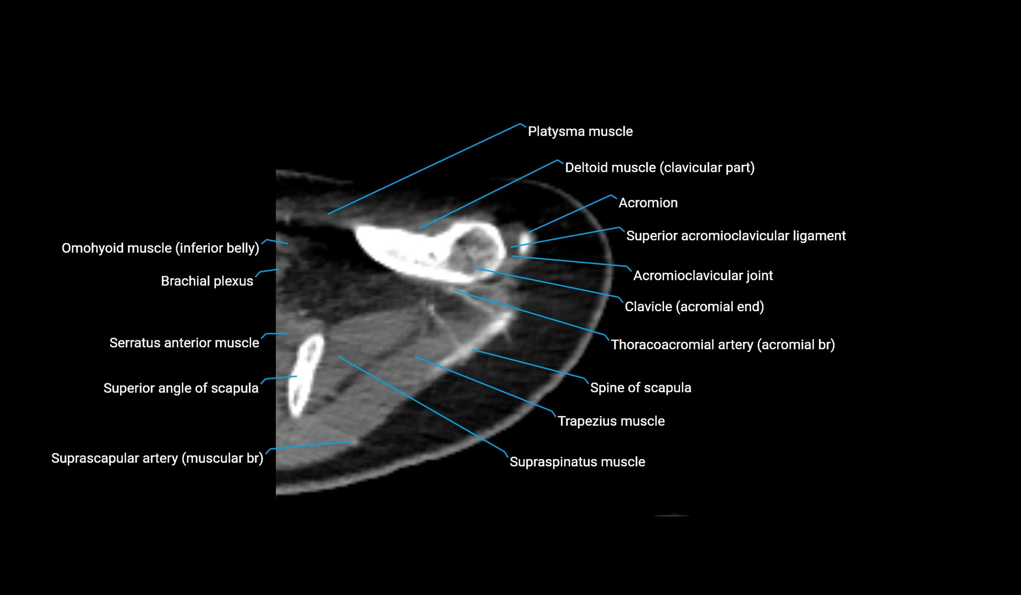 CT upper arm axial  cross sectional anatomy labelled radiology image -00058.webp